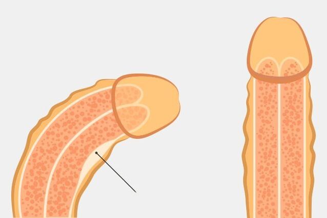 tehokas tapa suoristaa penis