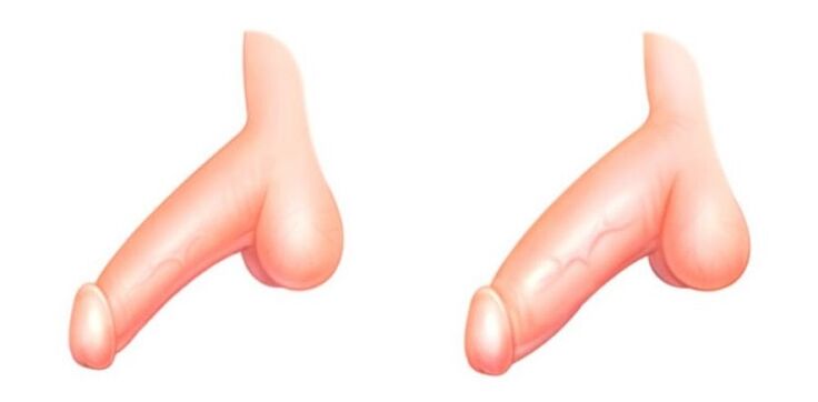 penis ennen ja jälkeen laajentumisen